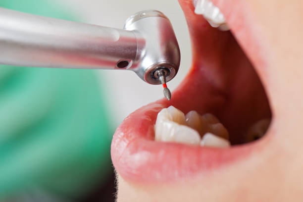 Best Root Canal Emergency Dentist  in Shady Hollow, TX